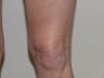Thermage of knee before