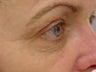 Thermage of eyes