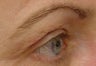 Thermage of eyes before and after