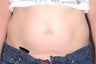 Thermage for Body - (Tummy/Abdomen)