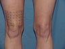 Thermage of kneees before and after