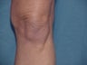 Thermage of knee before