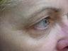 Thermage of eyes