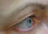Thermage of eyes before and after