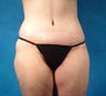 Thigh Lift