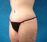 Thigh Lift