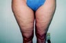 Thigh Lift