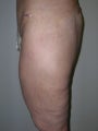 Thigh Lift