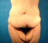 Thigh Lift