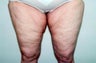 Thigh Lift