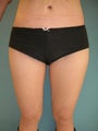 thighlift