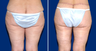 Thigh Lift