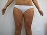 Thigh Lift 