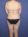 Thigh Lift