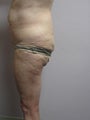 Lateral  Thigh Lift