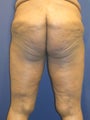 thighlift