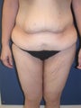 thighlift