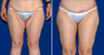 Thigh Lift