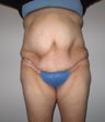 Abdominoplasty, thigh lift
