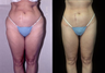 Thigh Lift