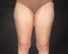 Thigh Lift