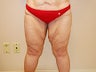 Thigh Lift 