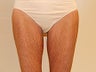 Thigh Lift
