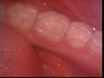 Tooth colored fillings