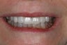 Cosmetic Dentistry - Fixed Bridge