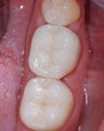 Mercury fillings replaced by white tooth colored fillings