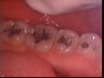 Tooth colored fillings
