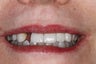 Cosmetic Dentistry - Fixed Bridge