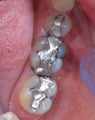 Mercury fillings replaced by white tooth colored fillings