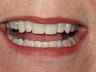 Reshaping of lower front teeth