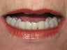 Reshaping of lower front teeth