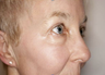 Deep/Active FX Laser Treatment