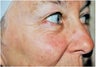 Deep/Active FX Laser Treatment