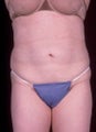 Liposuction