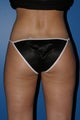 Liposuction