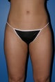 Liposuction