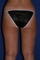 Liposuction