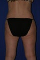 Liposuction