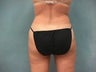 Liposuction
