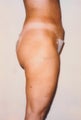 Liposuction