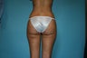 Liposuction of flanks and thighs