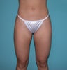 Liposuction of flanks and outer thighs
