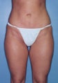 Power Assisted Liposuction (Hips, Thighs, Stomach & Back)