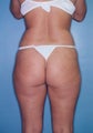 Power Assisted Liposuction (Hips, Thighs, Stomach & Back)