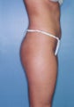 Power Assisted Liposuction (Hips, Thighs, Stomach & Back)