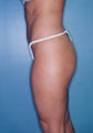Tumescent Liposuction